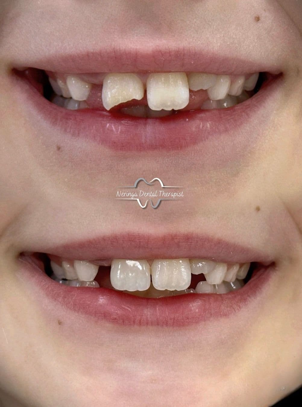 Aesthetic Dental Fillings