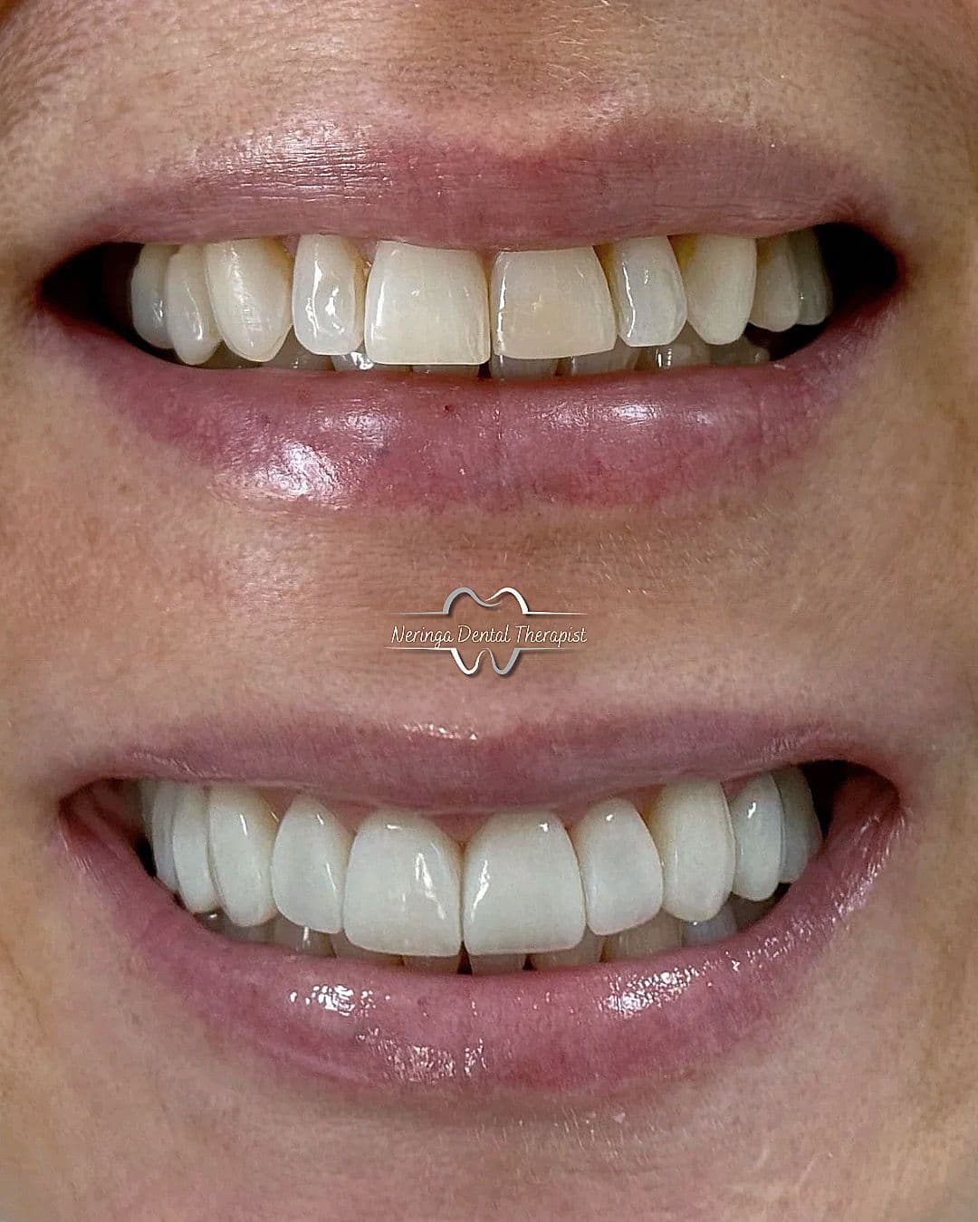Post Orthodontic treatment composite Veneers